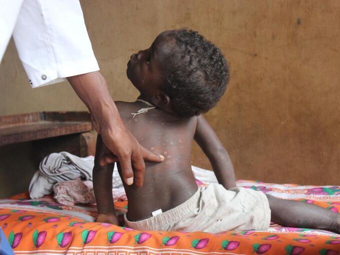 Lepra auf Madagaskar