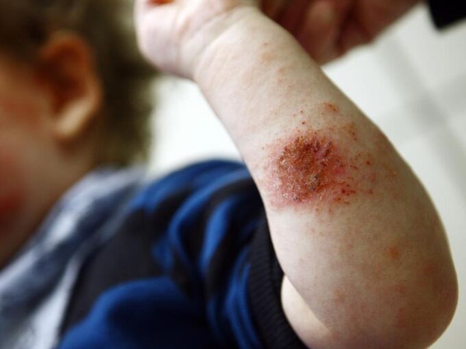 Ein Kind zeigt seinen mit Neurodermitis befallenen Unterarm