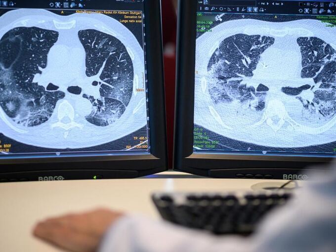 Zwei Monitore im Klinikum zeigen die Lunge eines Patienten