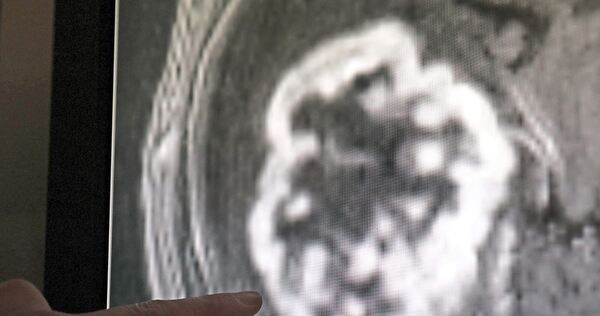 In der Diagnostik der Radiologie wird mit Hilfe der Magnetresonanztomographie ein Tumor festgestellt. Foto: dpa
