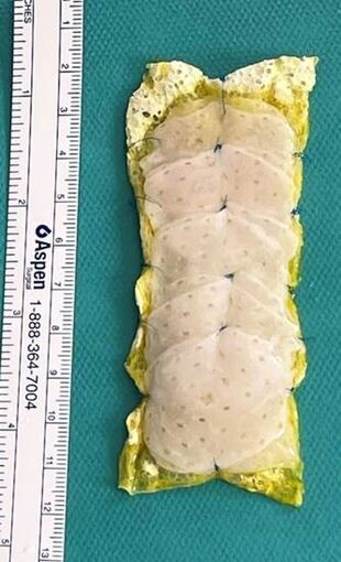 Herzpflaster aus Stammzellen