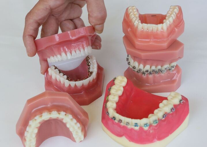 Zahnspangen Zahnspangen