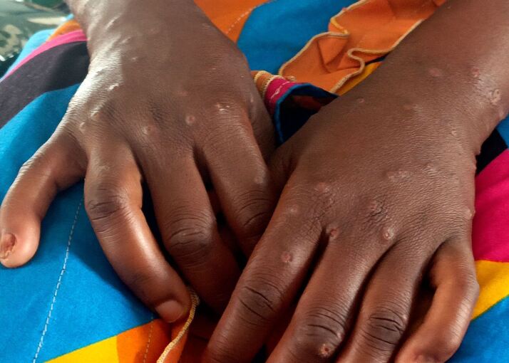Mpox