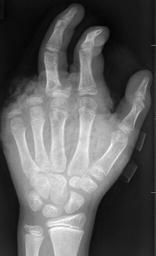 Böllerverletzungen Böllerverletzungen