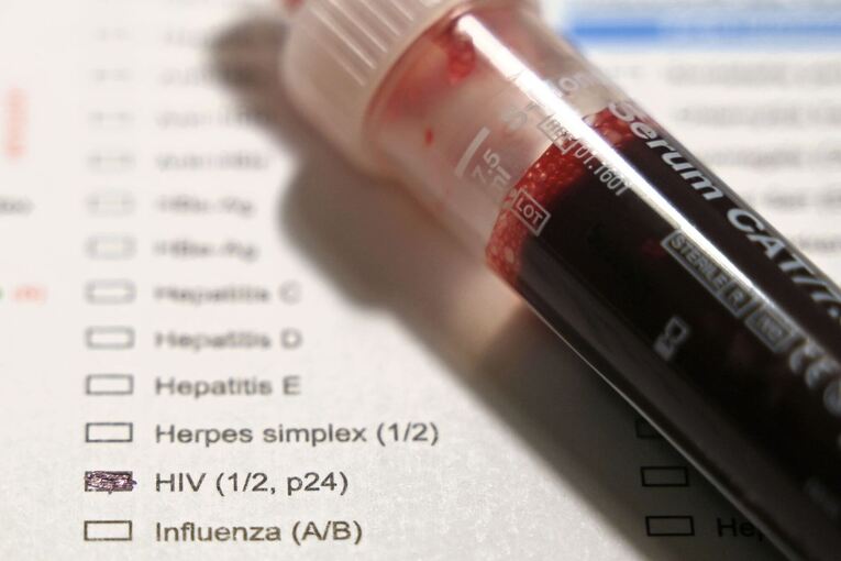HIV-Untersuchung